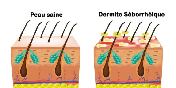 Comment Savoir Si On A Une Dermite Séborrhéique Planetefemmes