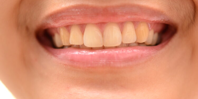 Comment protéger ses dents la nuit