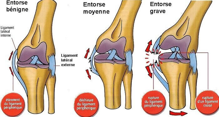 Comment Soigner Une Douleur Ligamentaire Au Genou Planetefemmes