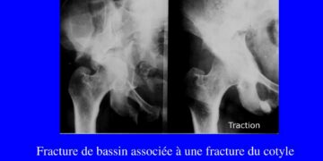 Quelles sont les séquelles d'une fracture du bassin ?
