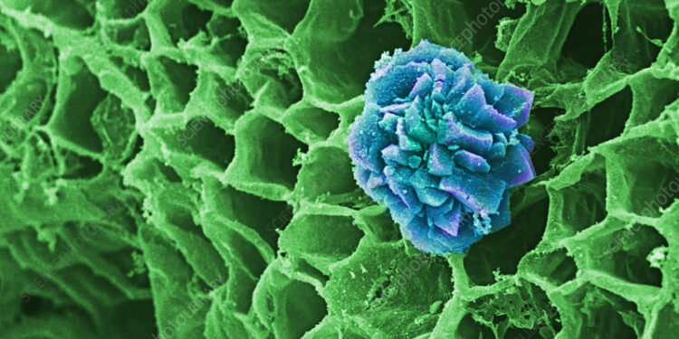 What Foods To Avoid If You Have Calcium Oxalate Kidney Stones 